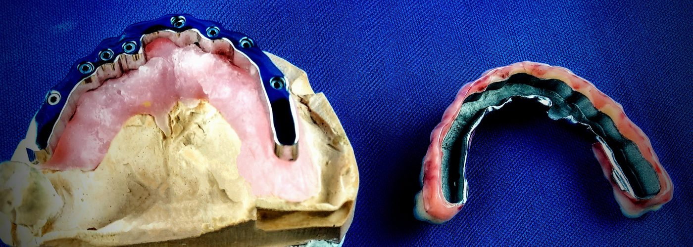 Prothèse télescopique : barre et intrados